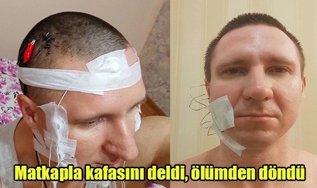 Matkapla kafasını deldi, ölümden döndü