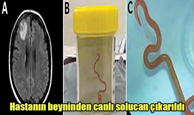 Hastanın beyninden canlı solucan çıkarıldı