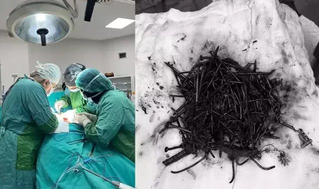 Zihinsel engelli kadın hastanın midesinden 1 kilo metal cisim çıktı