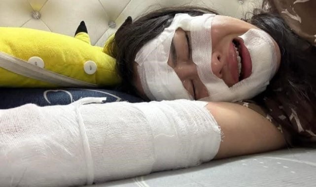 Vietnam'da doğum gününde elinde patlayan balon kadının yüzünü yaktı